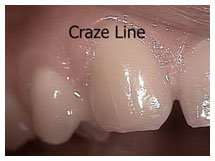 What Are the Craze Lines?