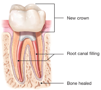endodontic retreatment root canal crown