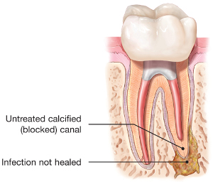 endodontic retreatment tooth abscess