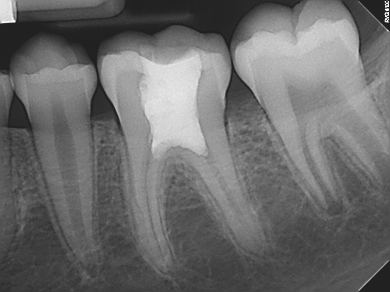 May 2017 - Immature Molar Apex Case - EndoExperience