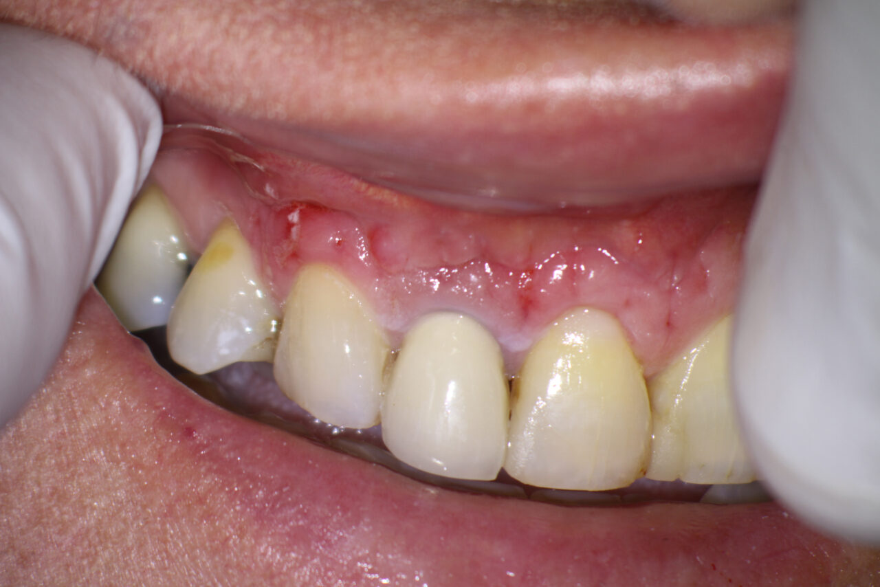 August 2021 - Surgical Endo Failure Due to Unusual Root Fracture ...